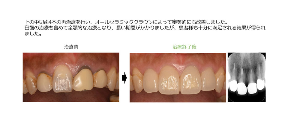 上の前歯の色の不調和と歯茎の炎症を改善