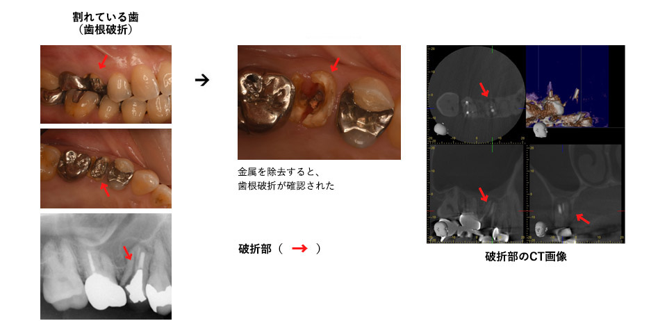 歯根破折（根が割れた歯） の治療症例