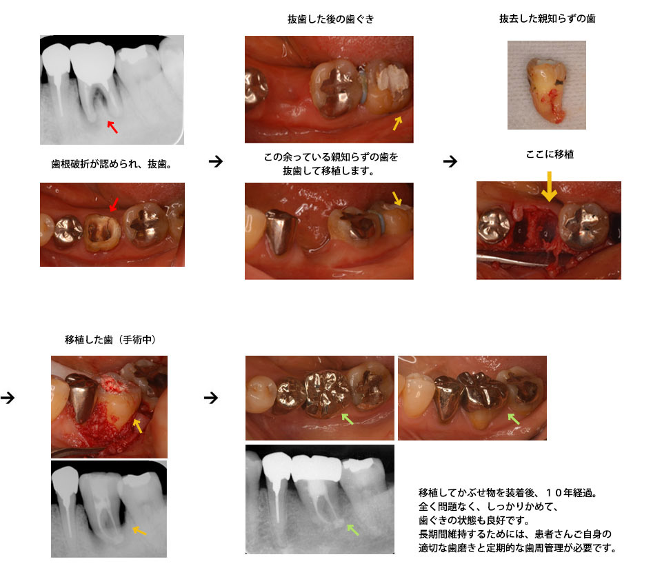 歯の移植治療症例1（58歳/女性）