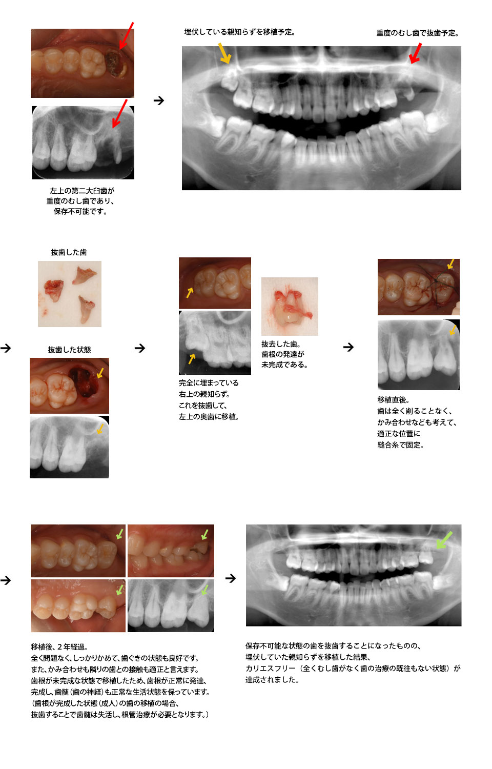 歯の移植治療症例2（16歳/女性）