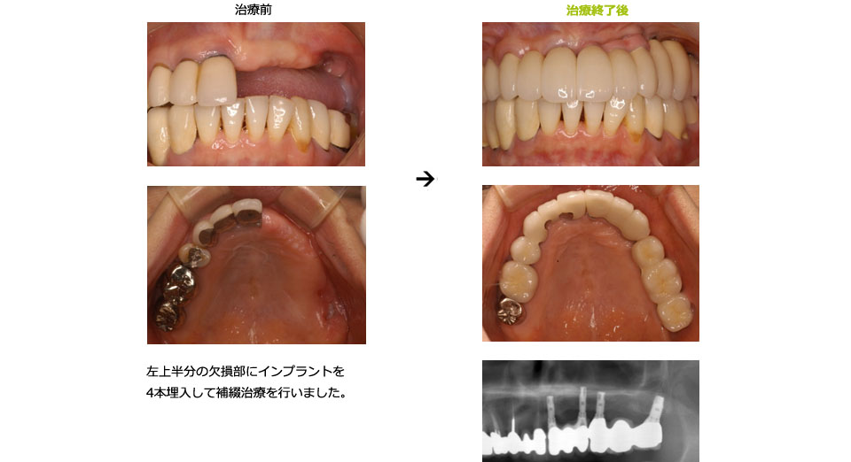 右上臼歯部へのインプラント適応例