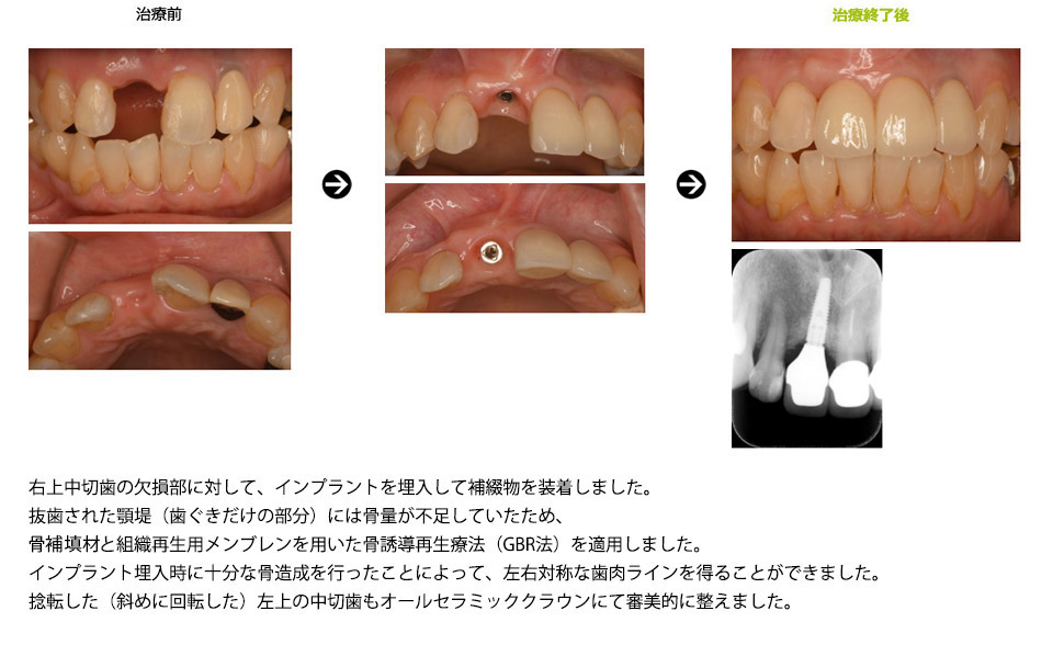 前歯の1本欠損に対してインプラント治療を行なった症例