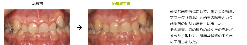 軽度な歯周病の治癒例